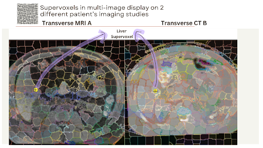 MRI and CT Supervoxels with same anatomical regions highlighted